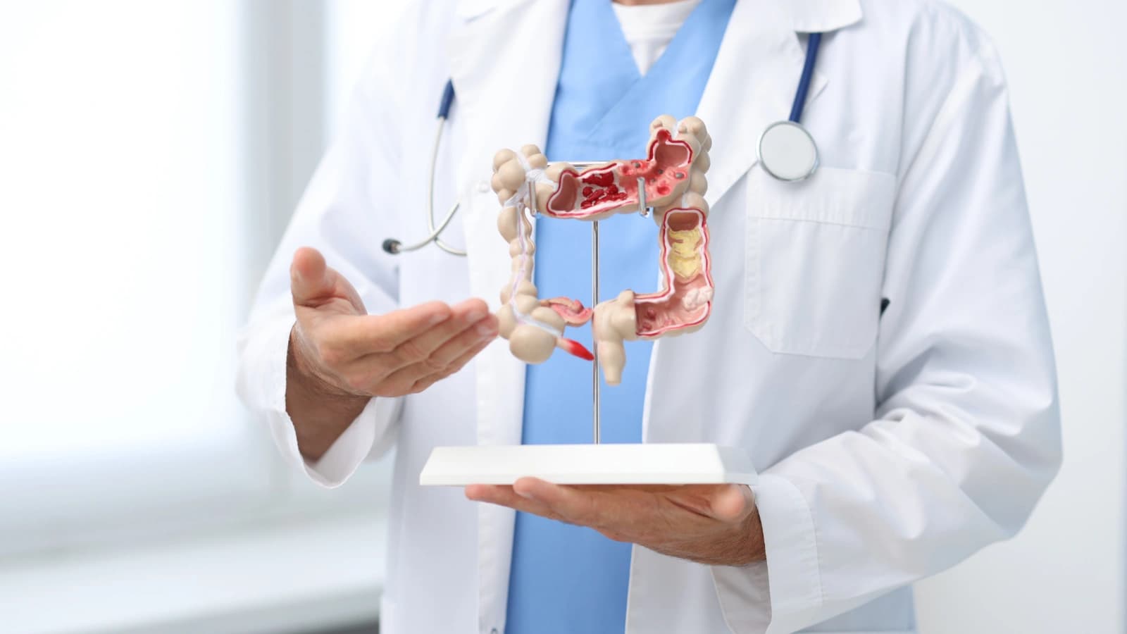 Diverticulose e Diverticulite — O que é diverticulite?
