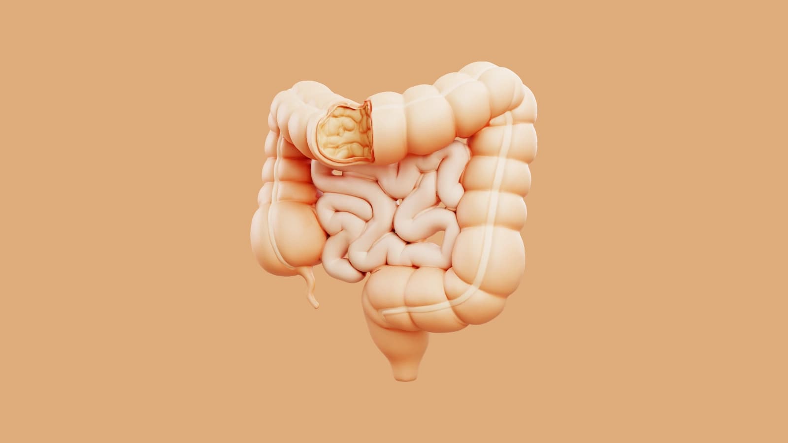 Diverticulose e Diverticulite