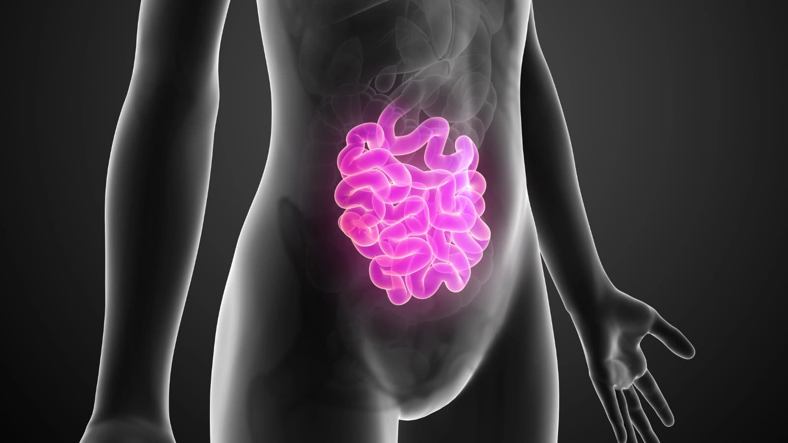 Doenças Inflamatórias Intestinais (DII) — Retocolite Ulcerativa