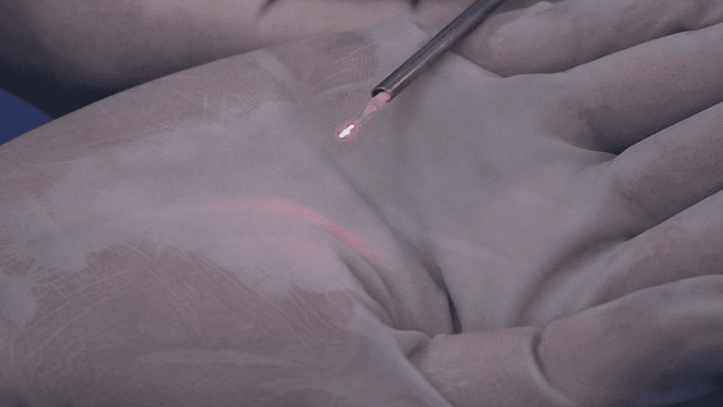 Tratamento de cisto pilonidal com Laser de Diiodo