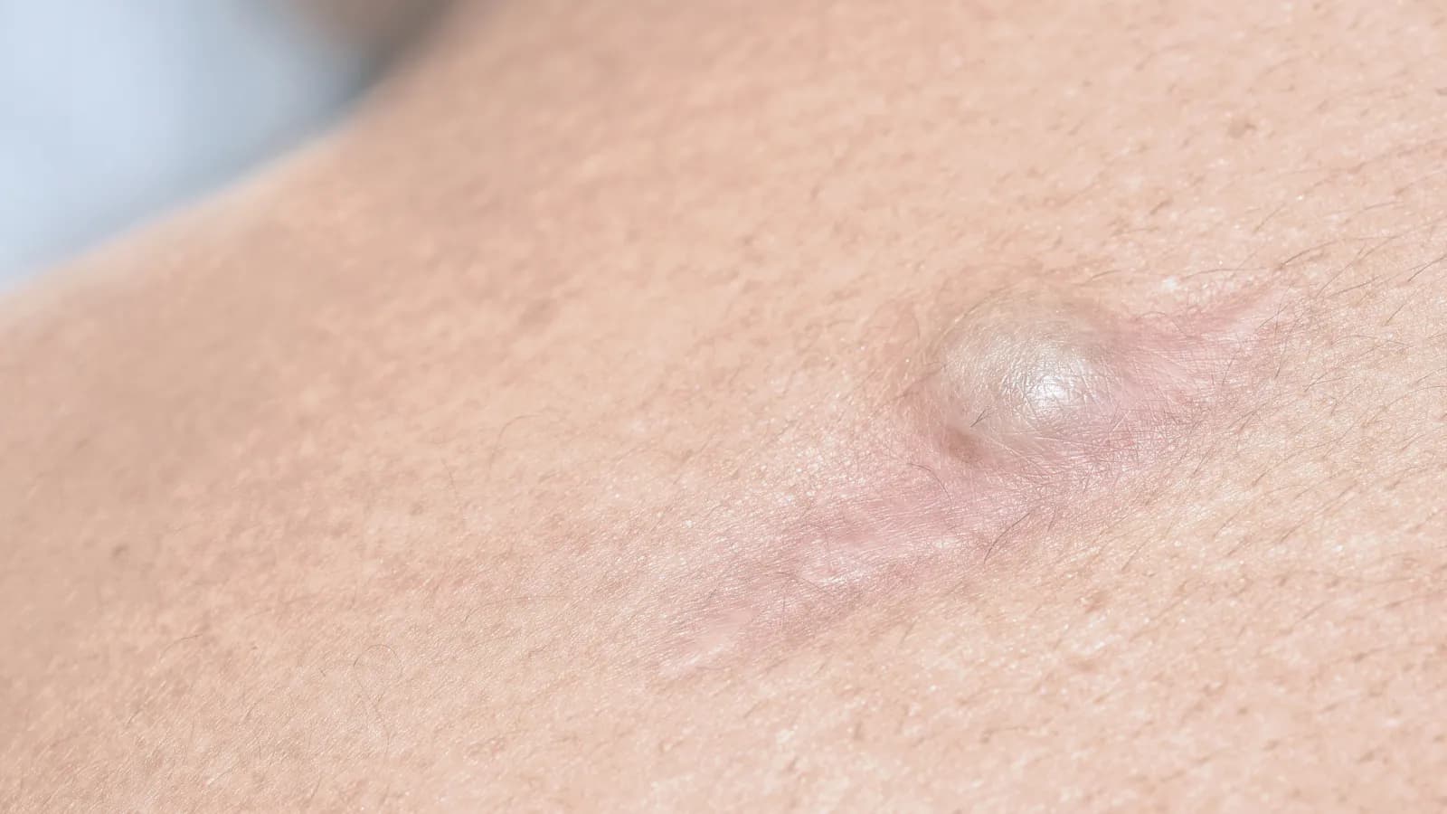 Cisto Pilonidal