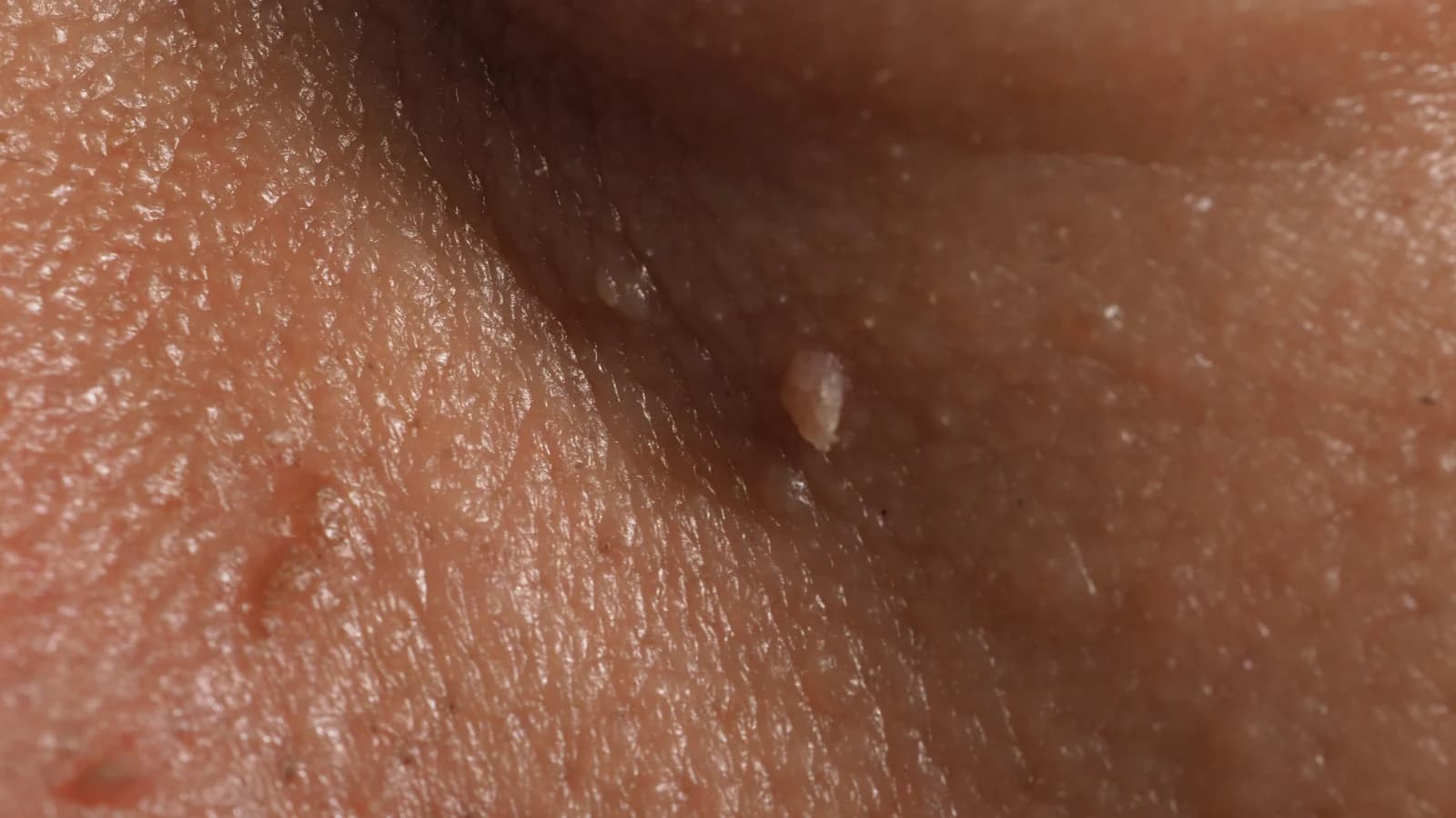 Condiloma Anal (HPV)