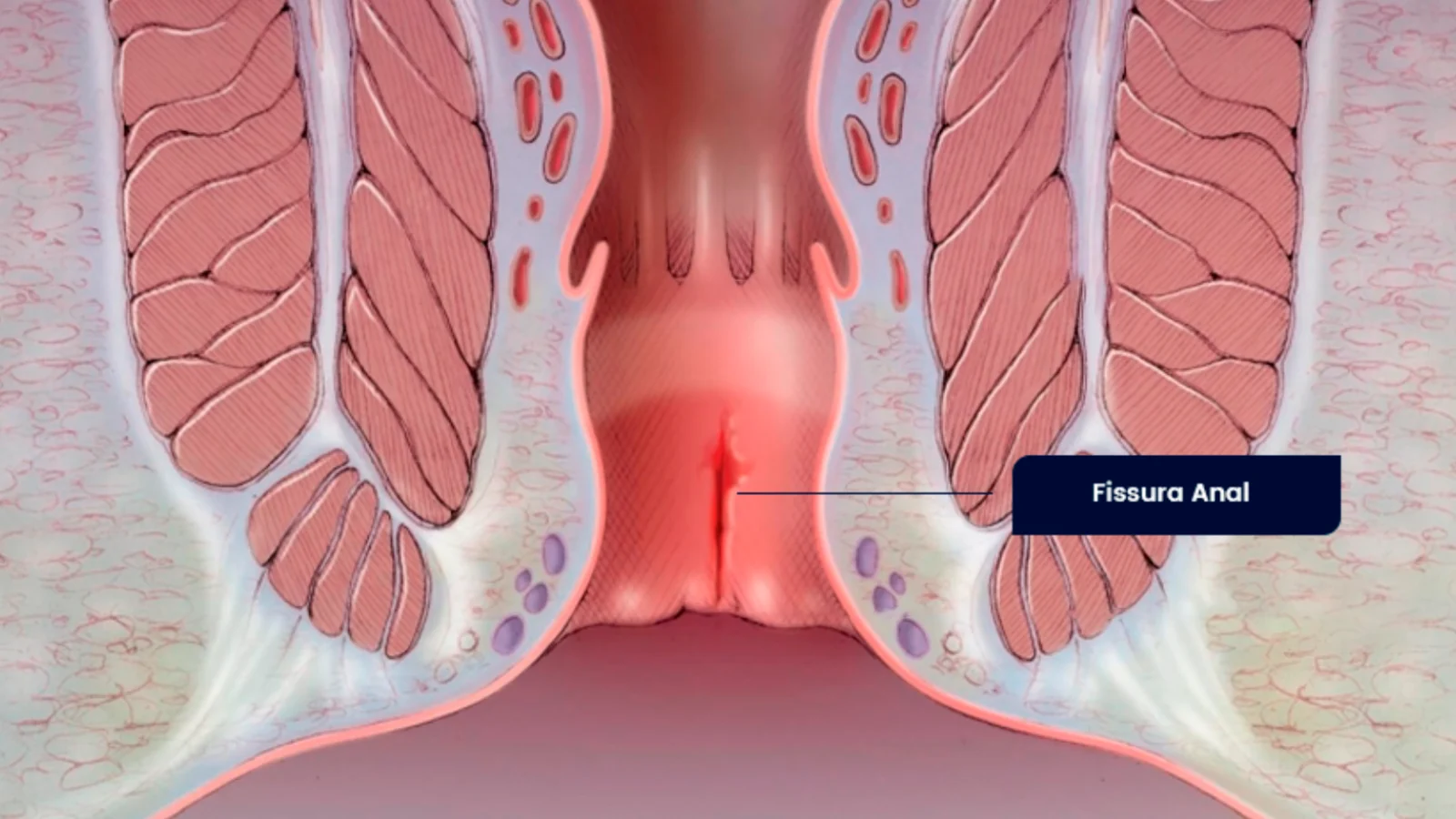 Fissura Anal — Por que a fissura não cicatriza?