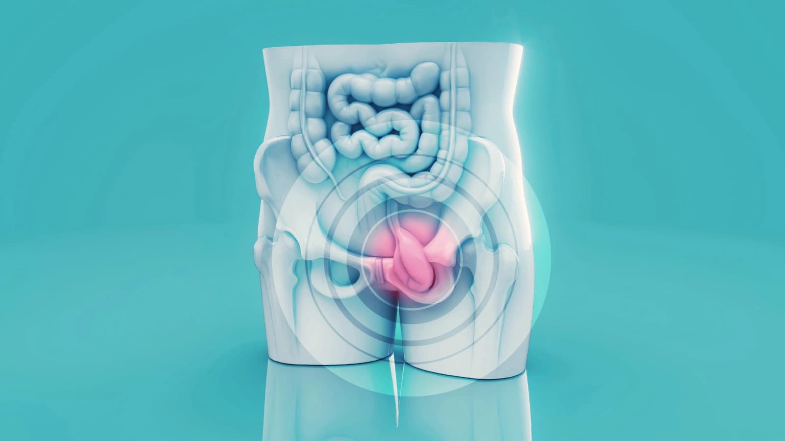Hemorroidas — O que é trombose hemorroidária?