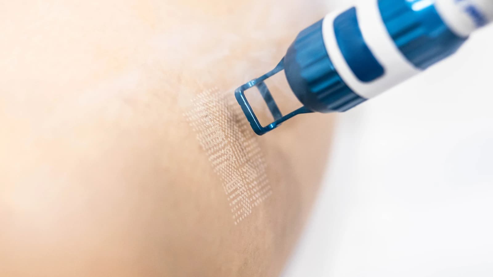 Hemorroidas — Hemorroidectomia com Laser de CO₂