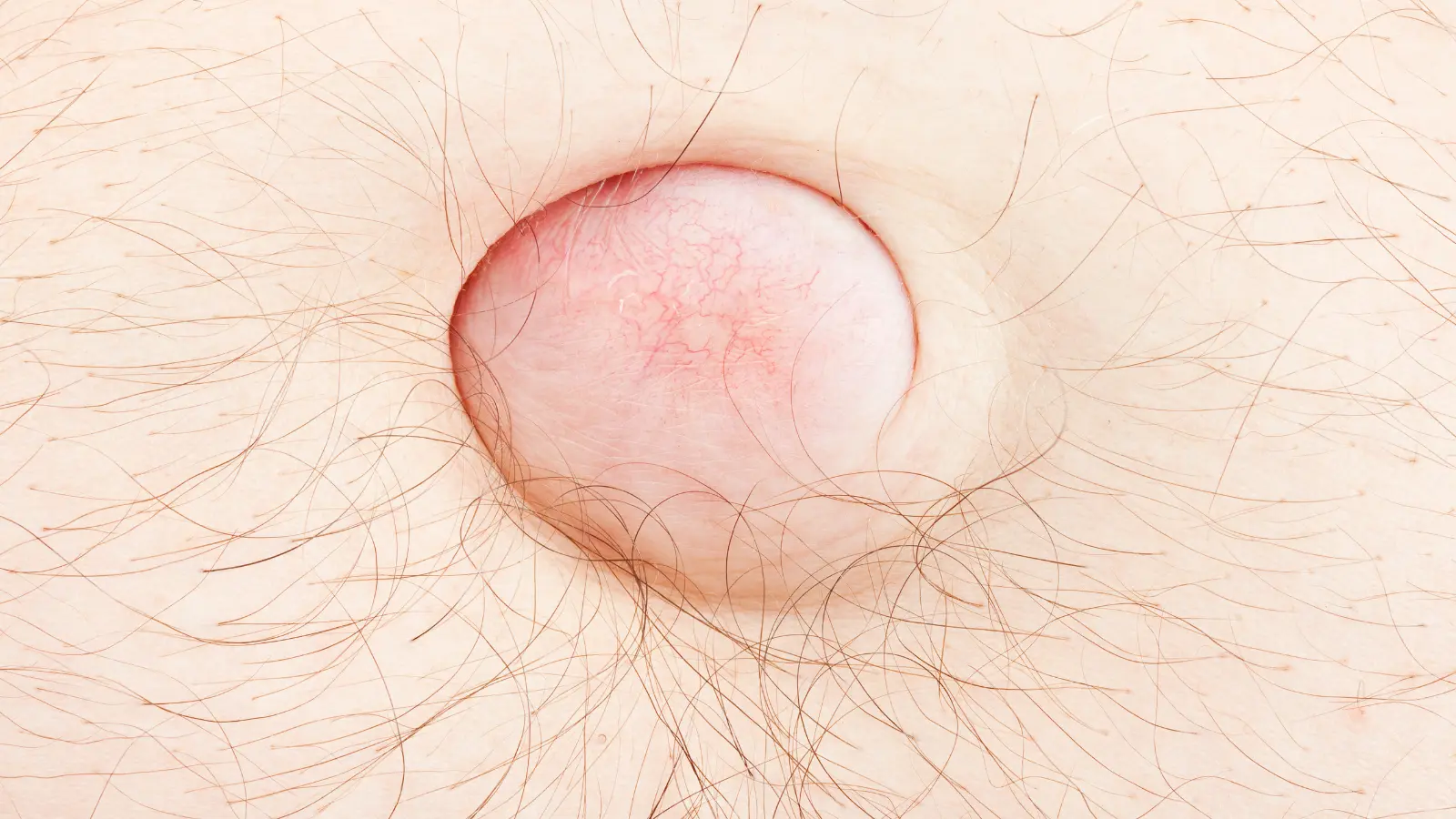 Hérnia Umbilical